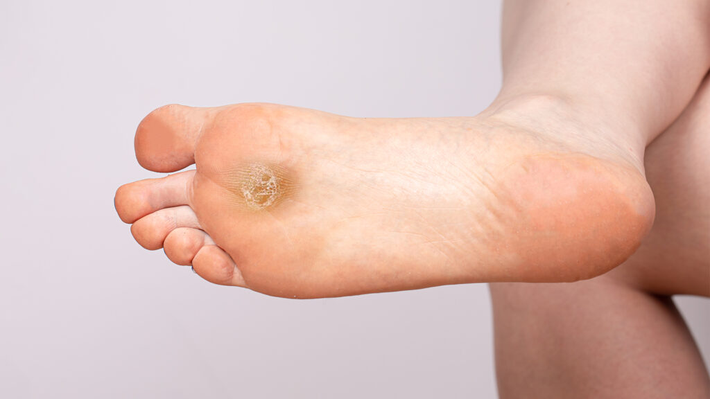 calluses on the bottom of feet after 50