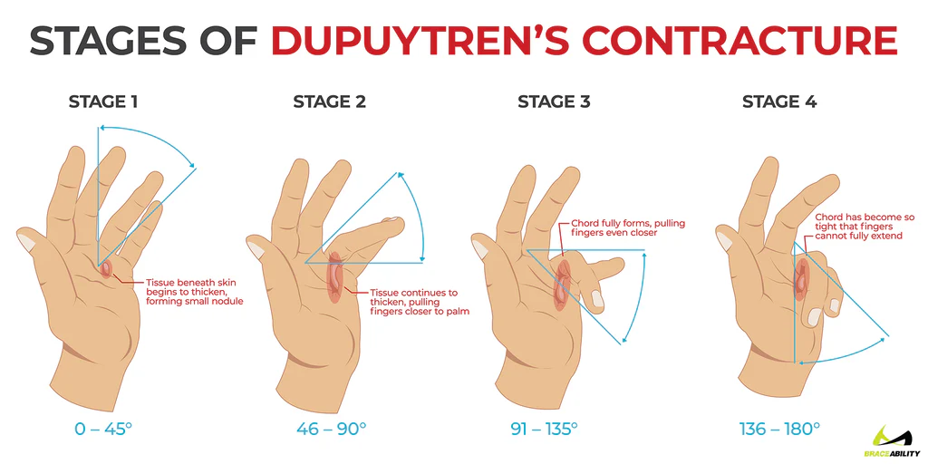 Hand cramps at night after 50, causing sudden finger tightening during sleep