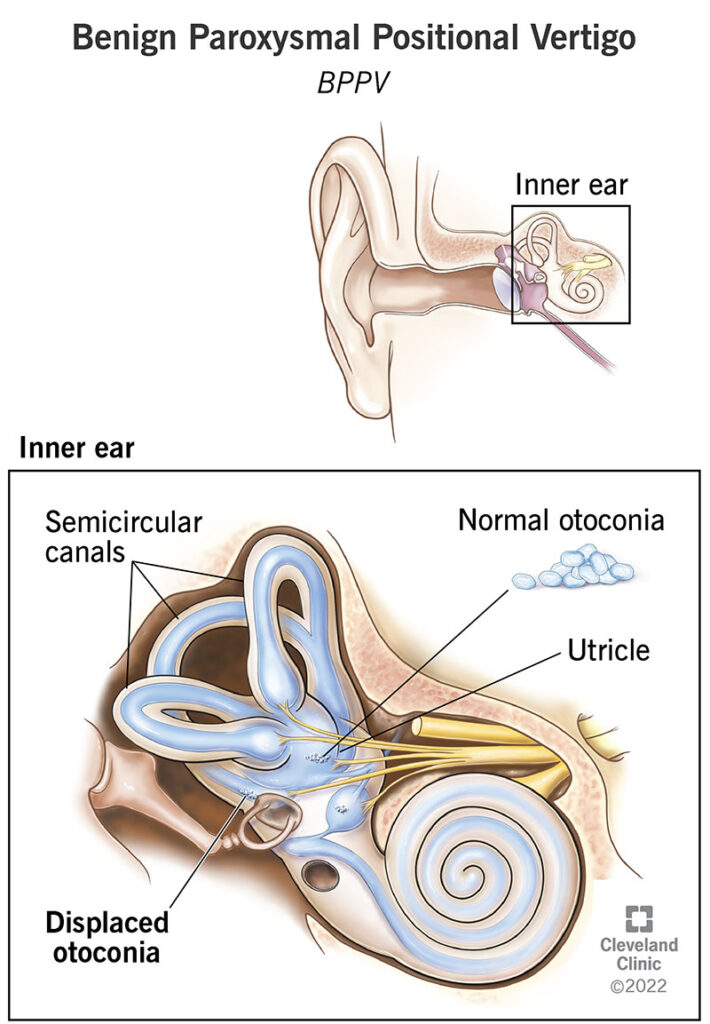 ears feel slightly off balance after 50 mild dizziness sensation