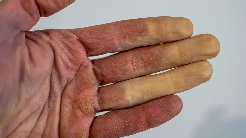 Fingers feel cold even when it’s warm after 50 due to circulation changes