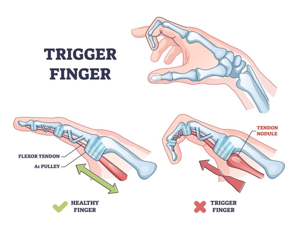finger locking Cramp at Night After 50