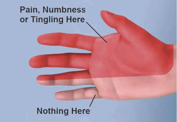 hands go numb when driving after 50 due to nerve pressure on the steering wheel