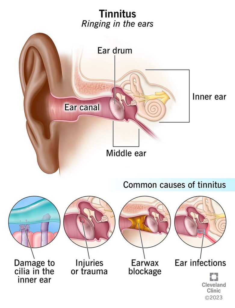 Ears ringing after 50