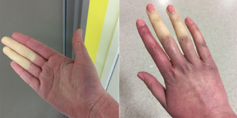hands turn white or pale after 50